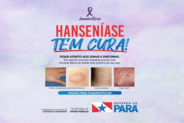 Janeiro Roxo tem diagnóstico e prevenção da Hanseníase como temas