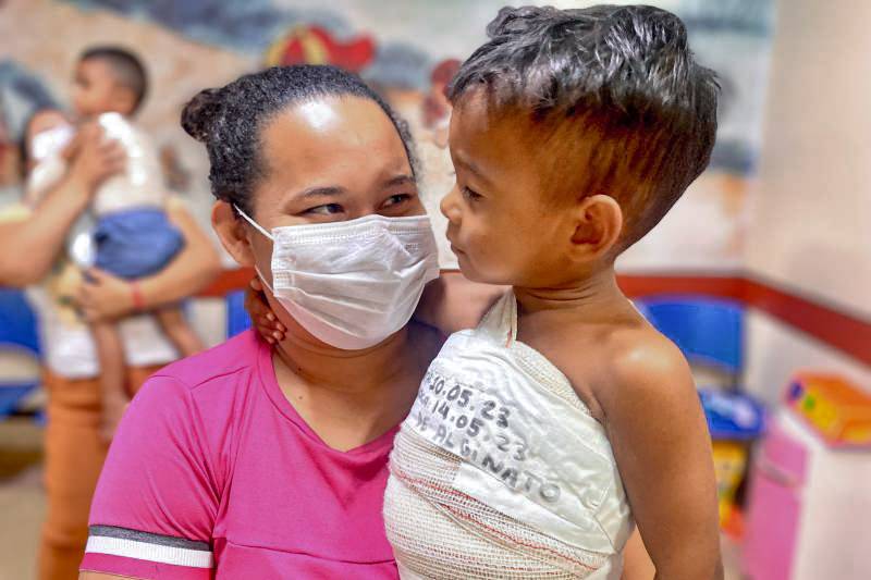 Hospital Metropolitano é referência no Norte para o tratamento de queimaduras Hospital Metropolitano é referência no Norte para o tratamento de queimaduras