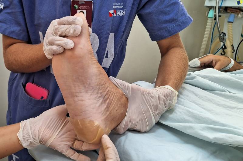 Time Cuidador de Pele do HRBA atua na prevenção de lesões por pressão Time Cuidador de Pele do HRBA atua na prevenção de lesões por pressão