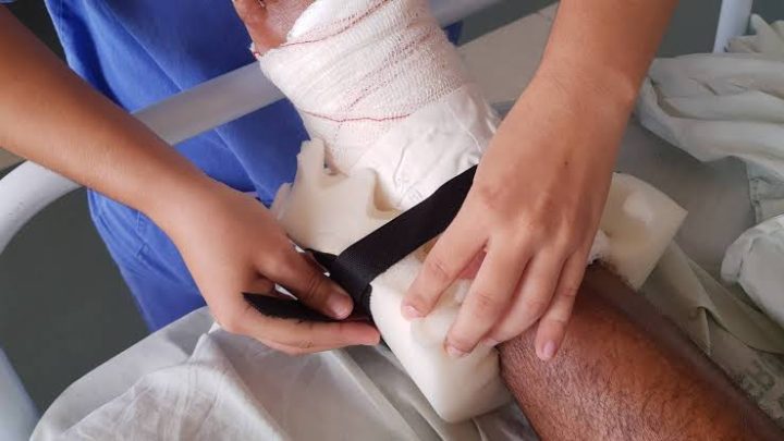 Em sete meses, laboratório de órteses do Hospital Metropolitano já produziu mais de mil dispositivos