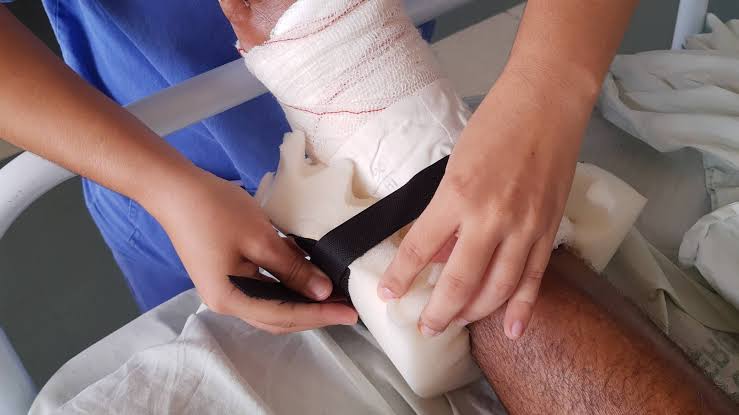 Em sete meses, laboratório de órteses do Hospital Metropolitano já produziu mais de mil dispositivos